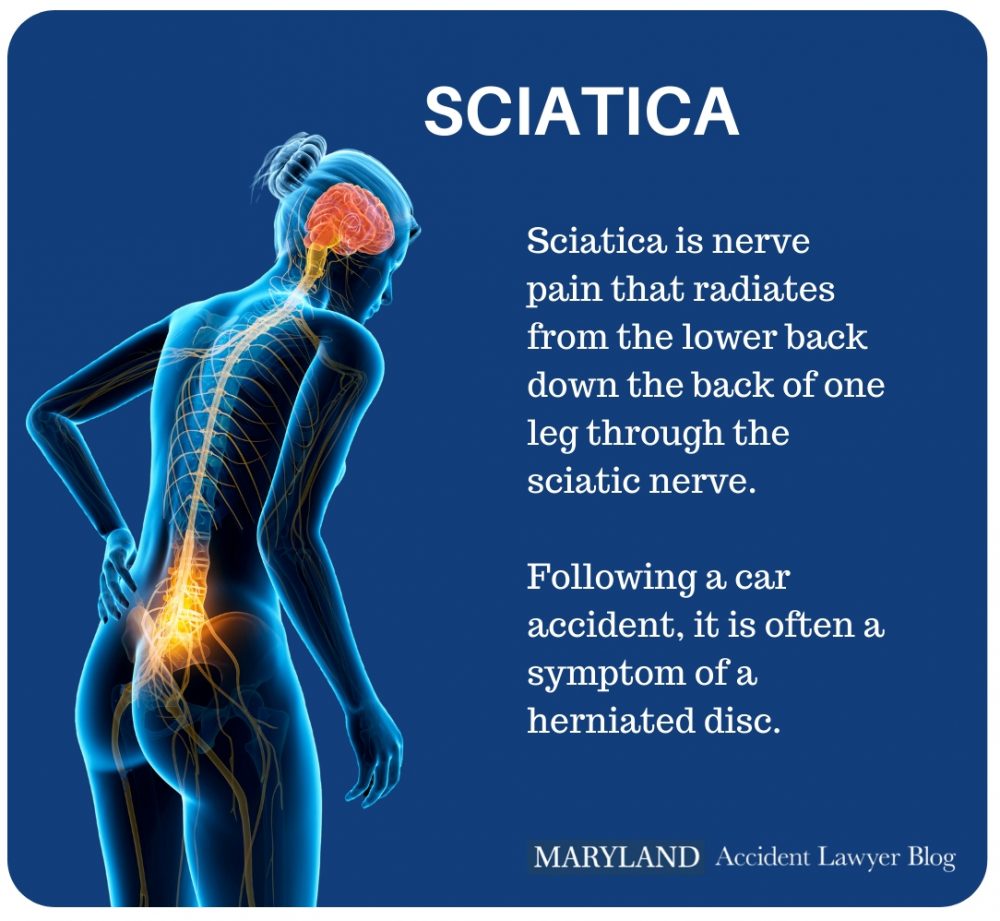 Sciatica Pain After A Car Accident Maryland Accident Lawyer Blog