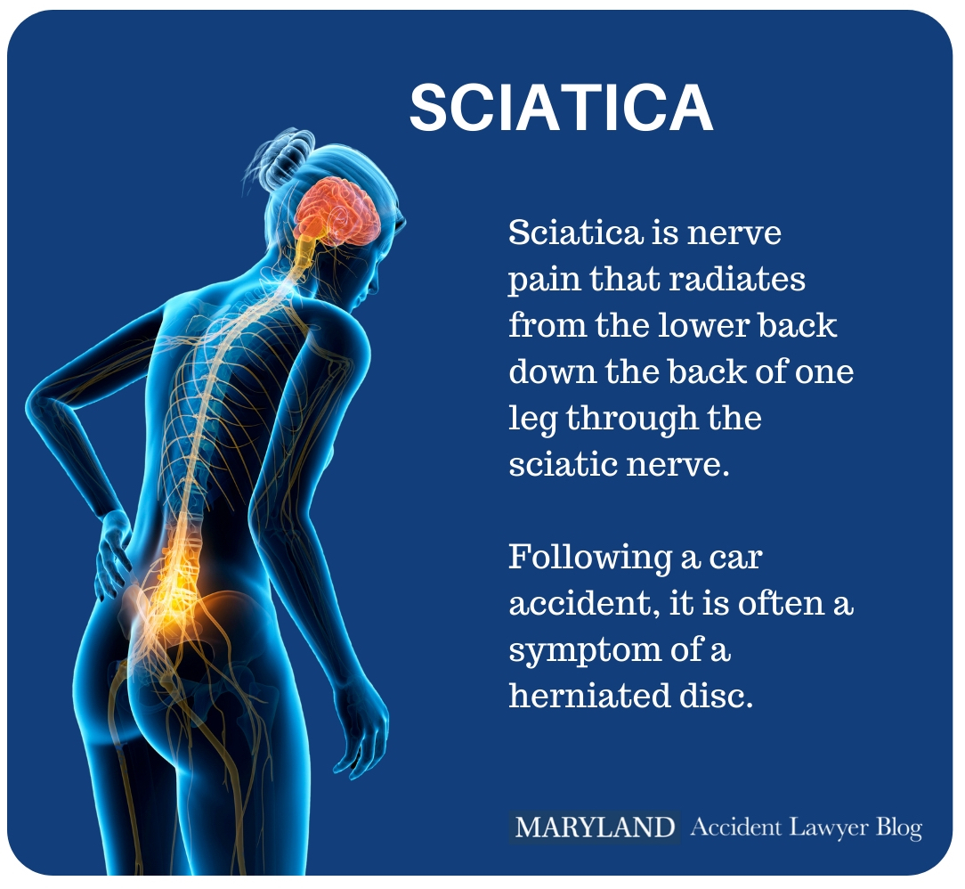 Sciatica Pain After A Car Accident Maryland Accident Lawyer Blog